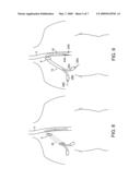 METHODS AND APPARATUS FOR INSERTING MULTI-LUMEN SPLIT-TIP CATHETERS INTO A BLOOD VESSEL diagram and image