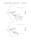 METHODS AND APPARATUS FOR INSERTING MULTI-LUMEN SPLIT-TIP CATHETERS INTO A BLOOD VESSEL diagram and image