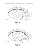 Treatment Medium Delivery Device and Methods for Delivery of Such Treatment Mediums to the Eye Using such a Delivery Device diagram and image