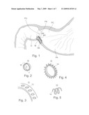 Pyloric Devices and Methods diagram and image