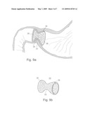 Pyloric Devices and Methods diagram and image