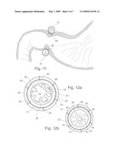 Pyloric Devices and Methods diagram and image