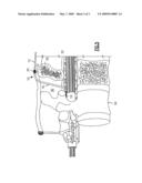 Strain Relief System For Spinal Cord Stimulation Lead diagram and image