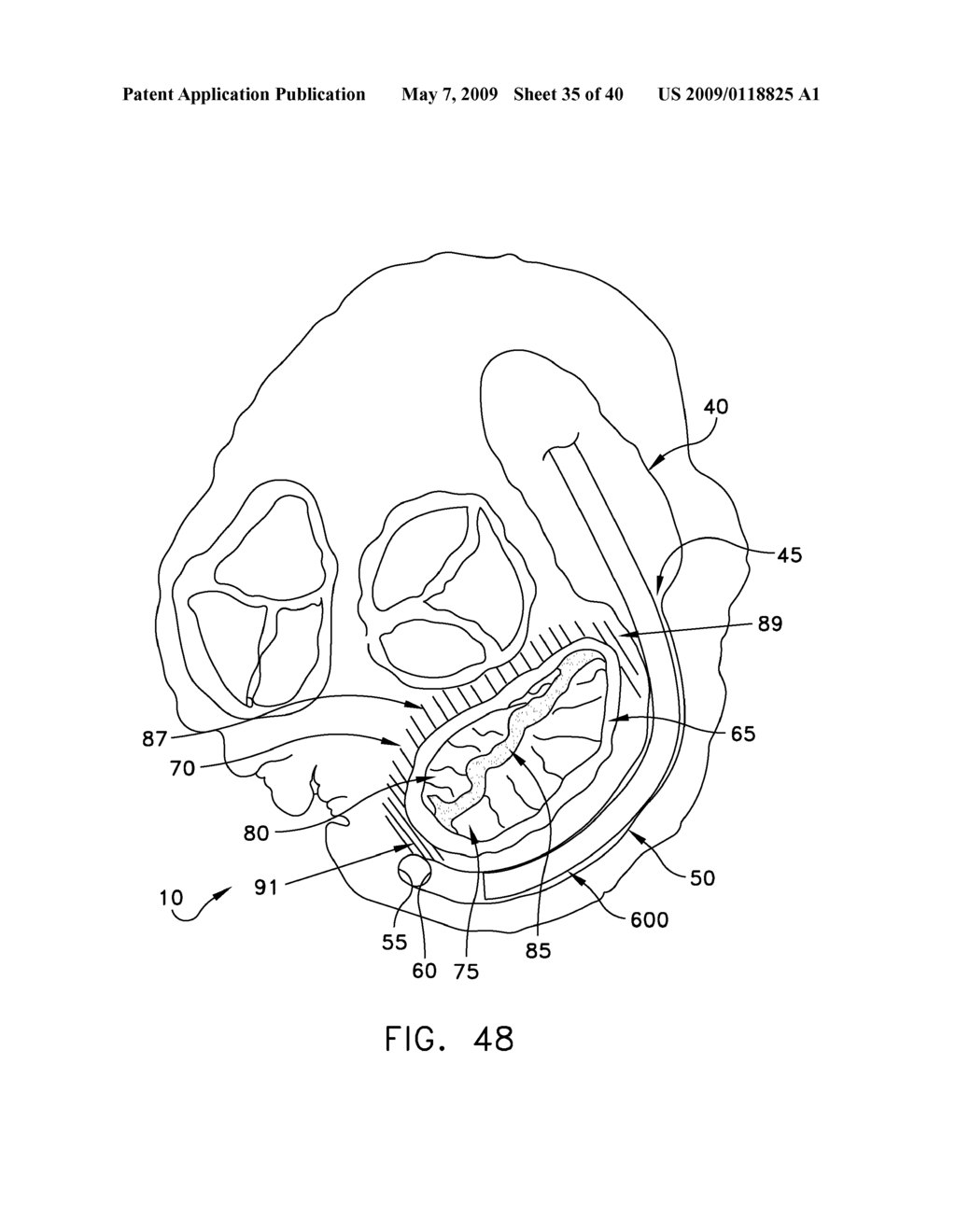 METHOD AND APPARATUS FOR IMPROVING MITRAL VALVE FUNCTION - diagram, schematic, and image 36