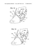 GARMENT FOR USE IN PUMP THERAPY FOR ENHANCING VENOUS AND ARTERIAL BLOOD FLOW diagram and image