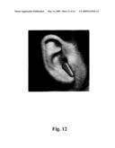 HEARING DEVICE WITH AN OPEN EARPIECE HAVING A SHORT VENT diagram and image