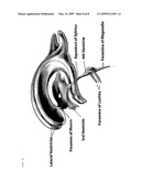SLOW INTRAVENTRICULAR DELIVERY diagram and image
