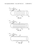 Wound Chamber For Limb diagram and image