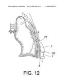 APPARATUS FOR SEALING, SECURING AND ADJUSTING THE LENGTH OF A FLEXIBLE TUBE diagram and image