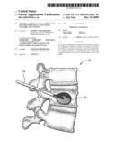 METHOD AND BONE CEMENT SUBSTITUTE KIT FOR STABILIZING A COLLAPSED VERTEBRA OF A PATIENT diagram and image