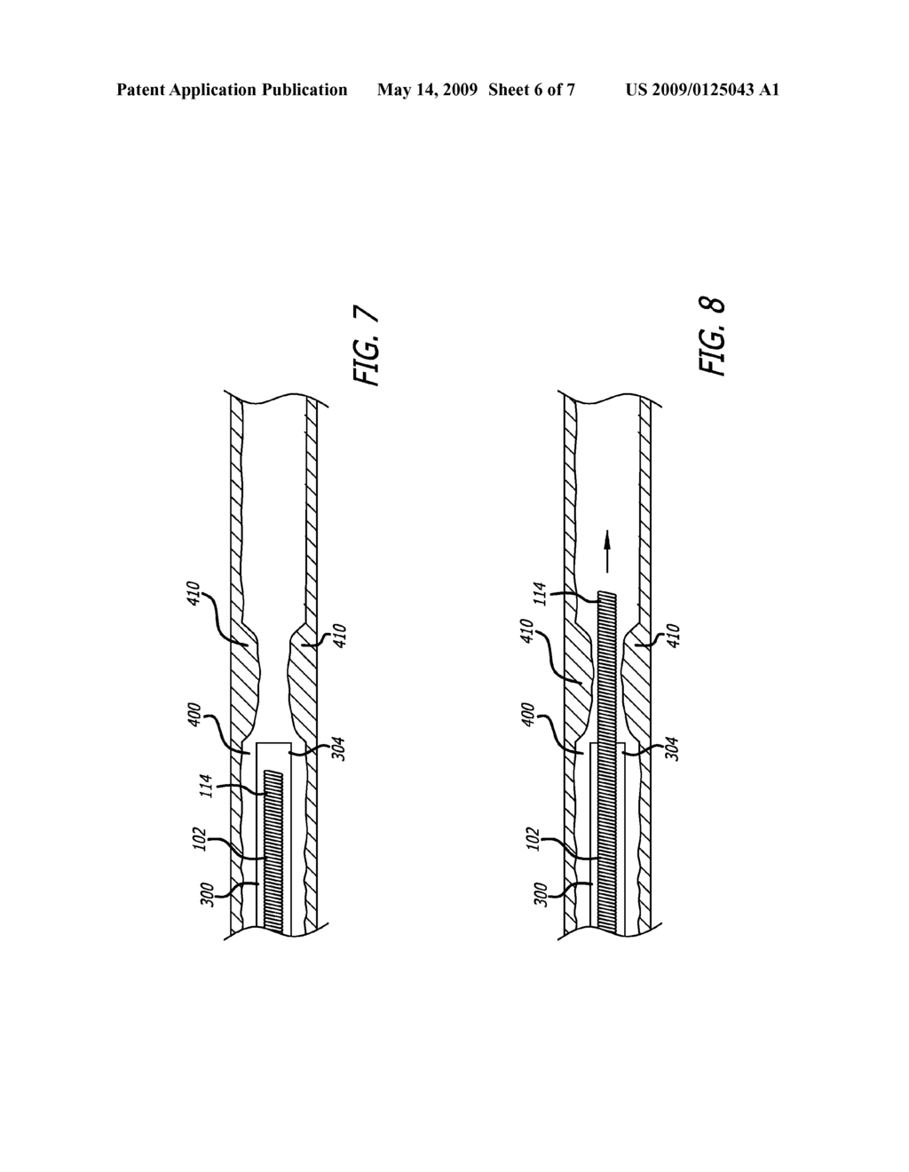 TETHERED COIL FOR TREATMENT OF BODY LUMENS - diagram, schematic, and image 07