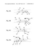 Treatment of Coronary Stenosis diagram and image