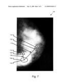 VOTING IN MAMMOGRAPHY PROCESSING diagram and image