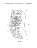 BONE ANCHOR AND SPINAL ALIGNMENT SYSTEM diagram and image