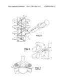 SPINE SUPPORT IMPLANT INCLUDING INTER VERTEBRAL INSERTABLE FLUID BALLASTABLE INSERT AND INTER-VERTEBRAL WEB RETAINING HARNESSES diagram and image