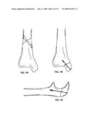 SYSTEM AND METHOD FOR THE FIXATION OF BONE FRACTURES diagram and image