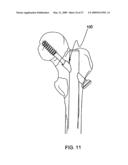 SYSTEM AND METHOD FOR THE FIXATION OF BONE FRACTURES diagram and image