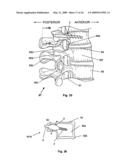 EXPANDABLE ATTACHMENT DEVICE AND METHOD diagram and image