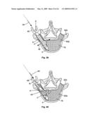 EXPANDABLE ATTACHMENT DEVICE AND METHOD diagram and image