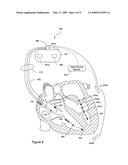 Hemodynamic status assessment during tachycardia diagram and image