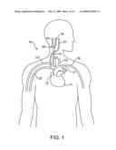 BAROREFLEX ACTIVATION THERAPY WITH CONDITIONAL SHUT OFF diagram and image