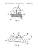 COMPOSITE STENT WITH INNER AND OUTER STENT ELEMENTS AND METHOD OF USING THE SAME diagram and image