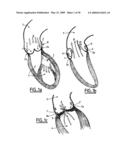 Valve prosthesis for implantation in body channels diagram and image