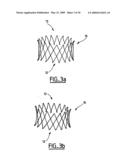 Valve prosthesis for implantation in body channels diagram and image