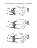 Valve prosthesis for implantation in body channels diagram and image