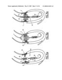 Valve prosthesis for implantation in body channels diagram and image