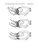 Valve prosthesis for implantation in body channels diagram and image