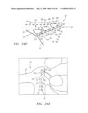 Prosthetic Heart Valves, Support Structures and Systems and Methods for Implanting the Same diagram and image