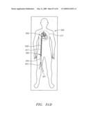 Prosthetic Heart Valves, Support Structures and Systems and Methods for Implanting the Same diagram and image