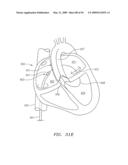 Prosthetic Heart Valves, Support Structures and Systems and Methods for Implanting the Same diagram and image