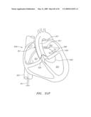 Prosthetic Heart Valves, Support Structures and Systems and Methods for Implanting the Same diagram and image