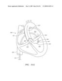 Prosthetic Heart Valves, Support Structures and Systems and Methods for Implanting the Same diagram and image