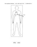 Prosthetic Heart Valves, Support Structures and Systems and Methods for Implanting the Same diagram and image