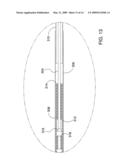 Ocular Implant Delivery System and Method diagram and image