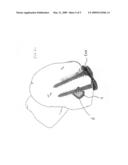 Implant for Use with an Osteotomy Plate diagram and image