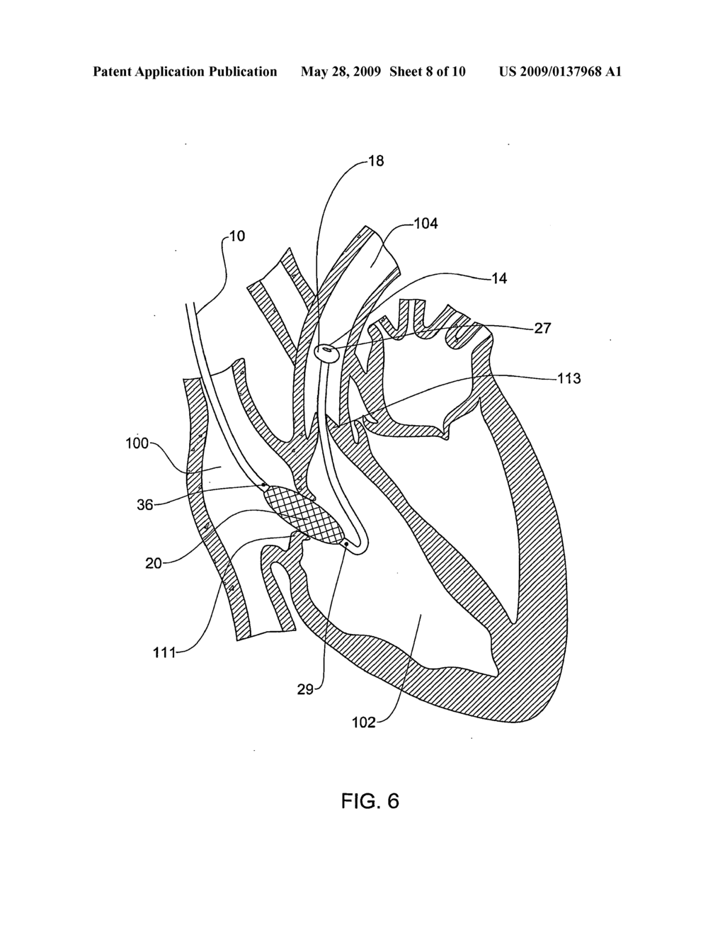 Apparatus for Controlled Blood Regurgitation Through Tricuspid Valve - diagram, schematic, and image 09