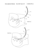 UTERINE MANIPULATORS diagram and image