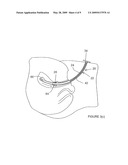 UTERINE MANIPULATORS diagram and image