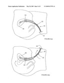 UTERINE MANIPULATORS diagram and image