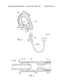 Guiding Catheter with Resiliently Compressible Occluder diagram and image