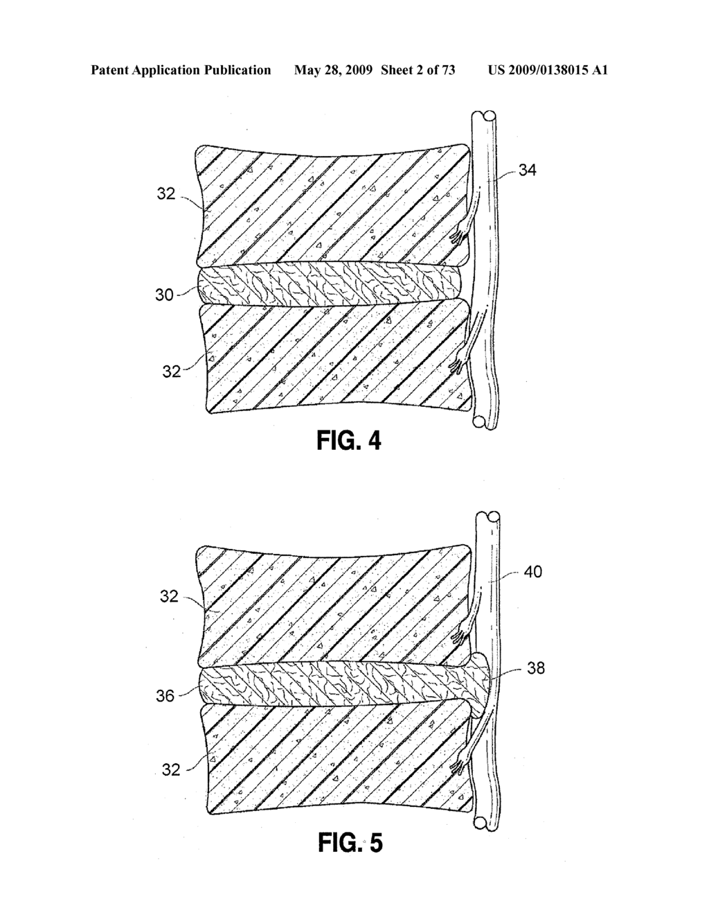 SPINAL IMPLANTS AND METHODS - diagram, schematic, and image 03