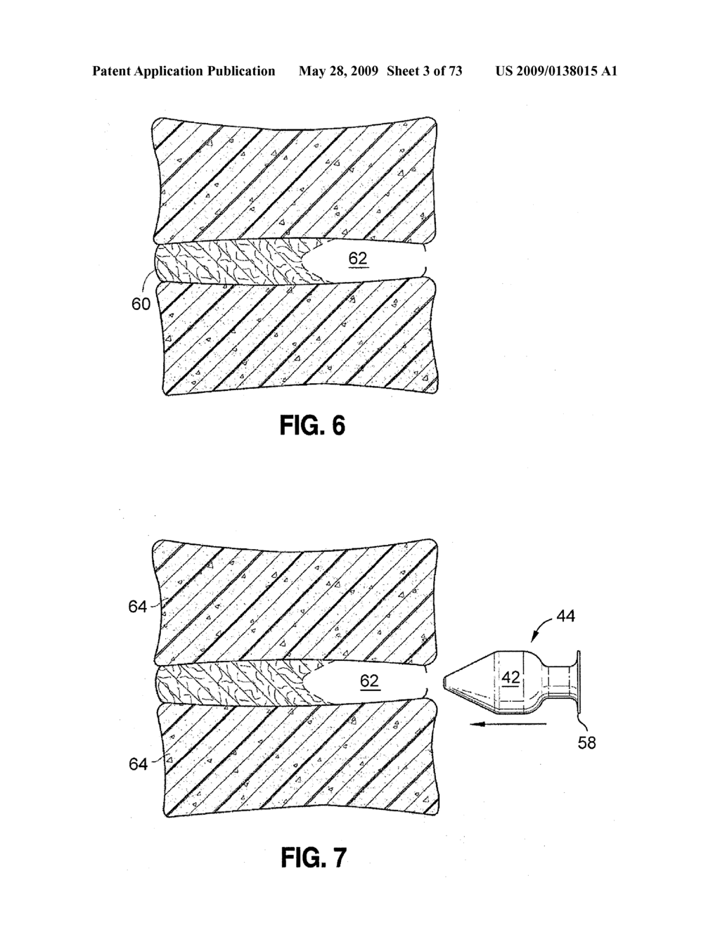 SPINAL IMPLANTS AND METHODS - diagram, schematic, and image 04