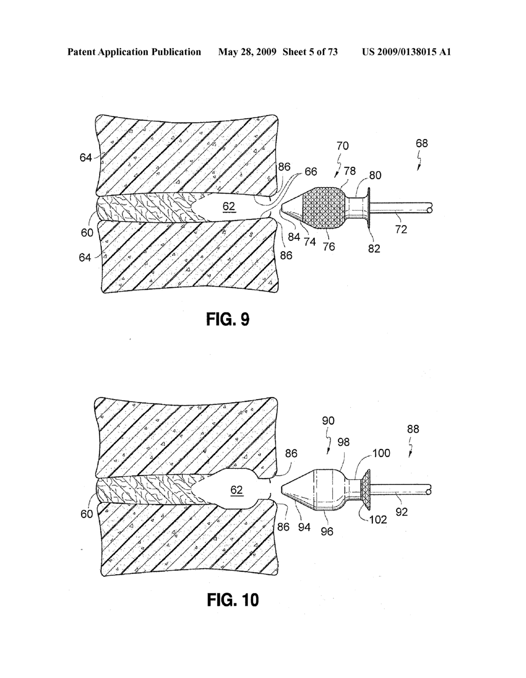 SPINAL IMPLANTS AND METHODS - diagram, schematic, and image 06