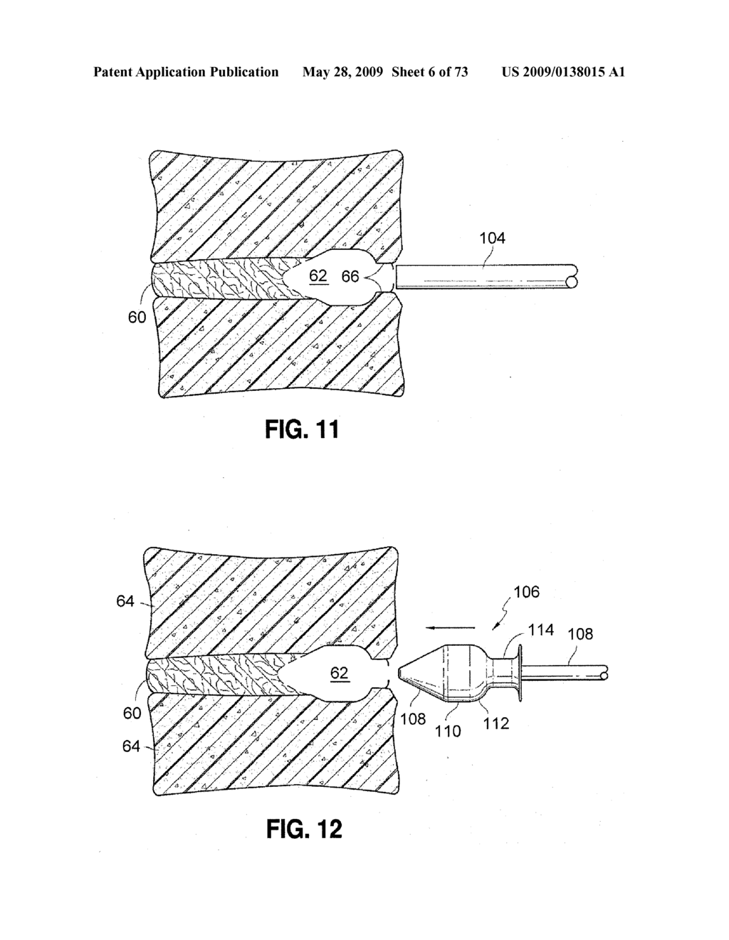 SPINAL IMPLANTS AND METHODS - diagram, schematic, and image 07