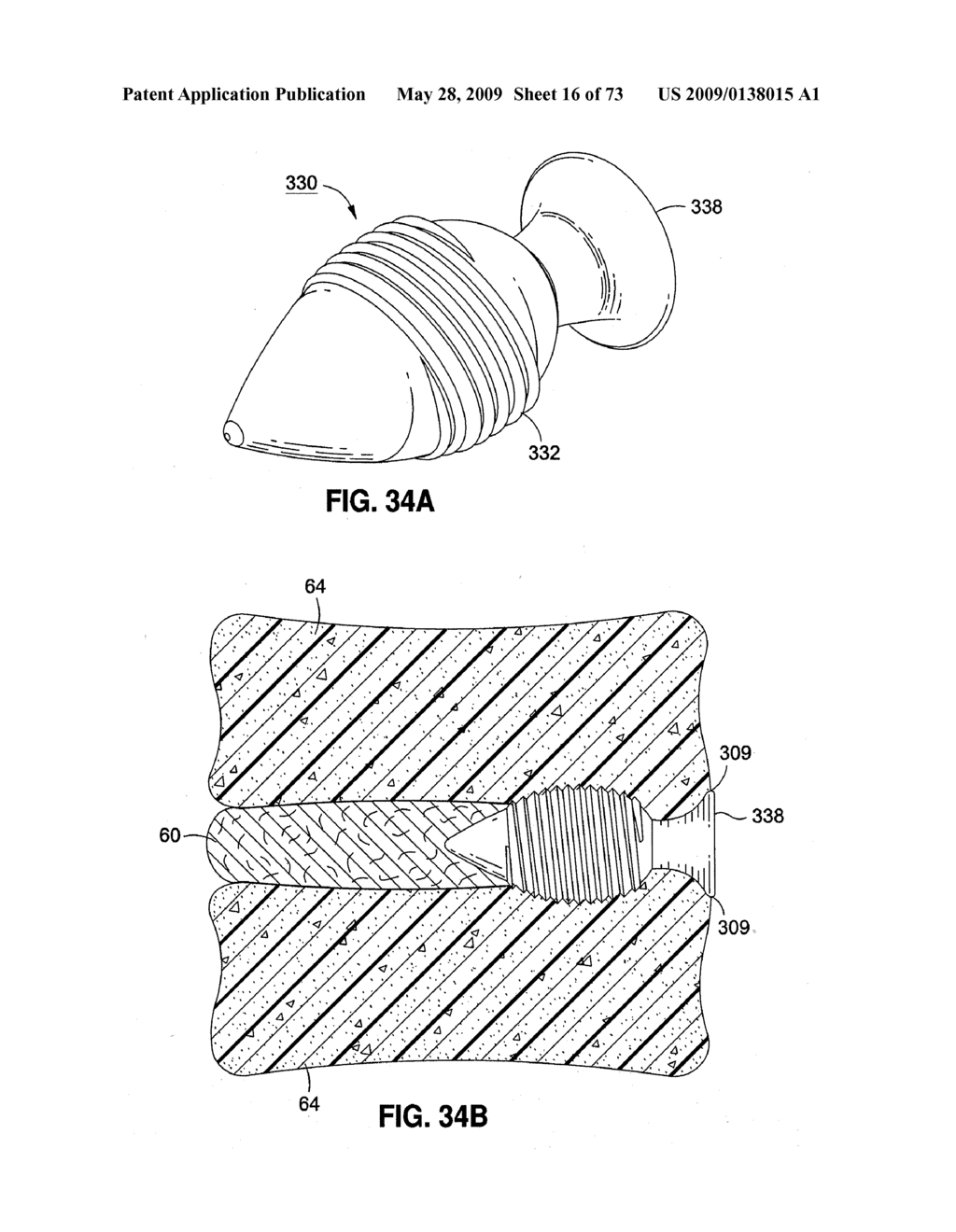 SPINAL IMPLANTS AND METHODS - diagram, schematic, and image 17