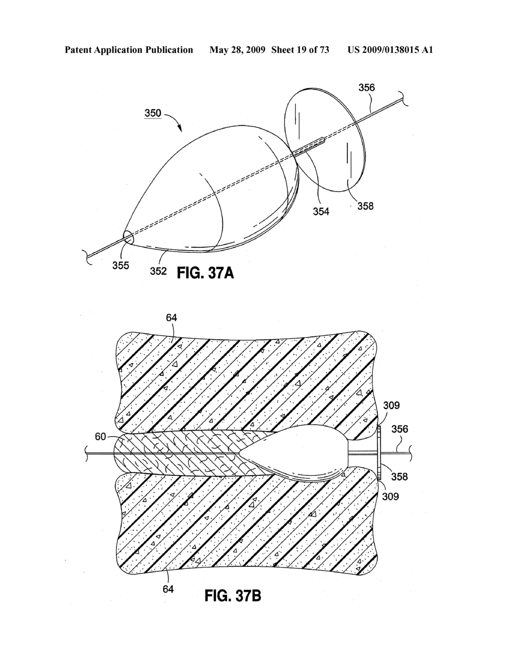 SPINAL IMPLANTS AND METHODS - diagram, schematic, and image 20